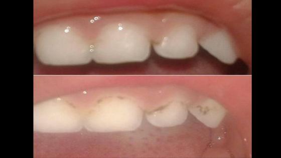جربت عشبة فسنينات خويا الصغير و حيدات ليه السوسة فالبلاصة