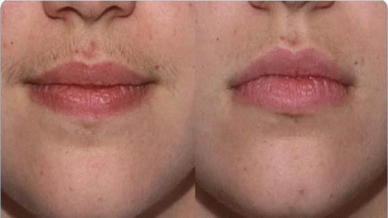 كيفاش تحيدي المسطاش .. دقة بطلة izalat el moustach
