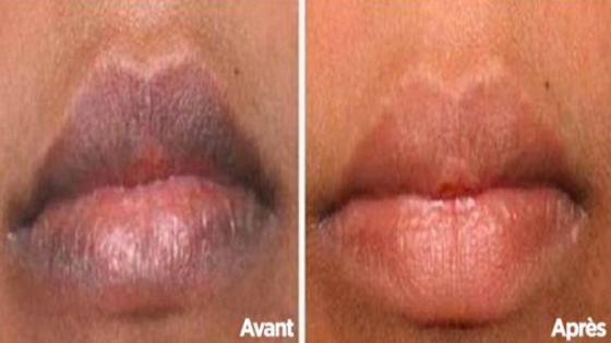 وصفة طبيعية لتنعيم الشفاه الداكنة وتفتيحها