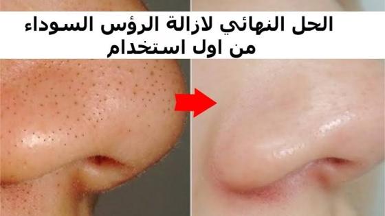 وصفة بسيطة تزيل الرؤوس السوداء والبيضاء والشعر الزائد من الوجه بسهولة