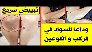 من أقوى الوصفات الجبارة في تبييض الركب وإزالة اسمرارها