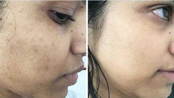 افضل طريقة لازالة البقع الداكنة من البشرة من اثار الصيف