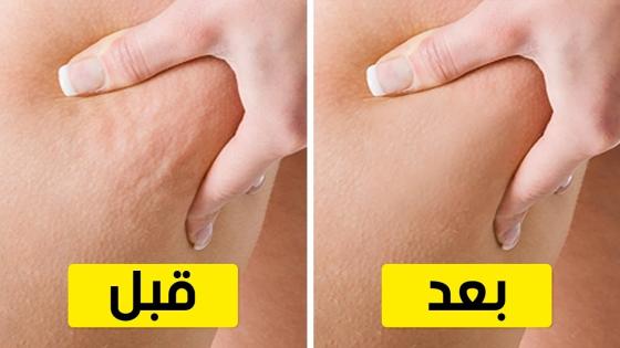 التخلص من السلوليت بصفة نهائية