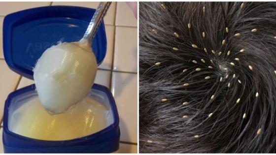 القمل هاجم هذه الأيام على الأطفال أو مساكن كيبقاو غير كيحكو…جبت ليك اقوى علاج مجرب