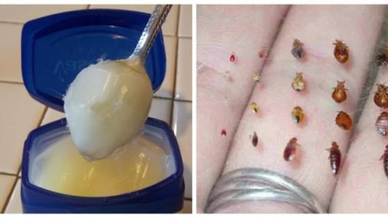 القمل هاجم هذه الأيام على الأطفال أو مساكن كيبقاو غير كيحكو…جبت ليك اقوى علاج مجرب