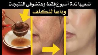 لن تعاني من بقع الكلف مرة أخرى هنا تجدين الحل النهائي لها وكأنها لم تكن يوما