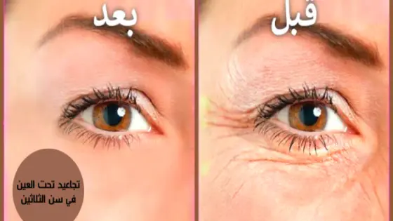 علاج تجاعيد الوجه والعينين بوصفات طبيعية جد فعالة
