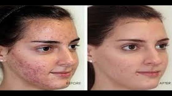 بوماضة ب 36 درهم فقط تهنيك من حب الشباب بمرة