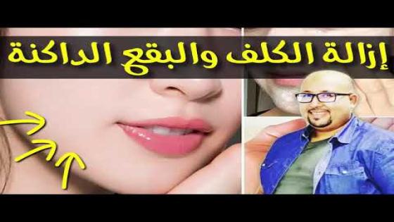 علاج الكلف والبقع الداكنة نهائيا من الوجه مع الدكتور عماد ميزاب