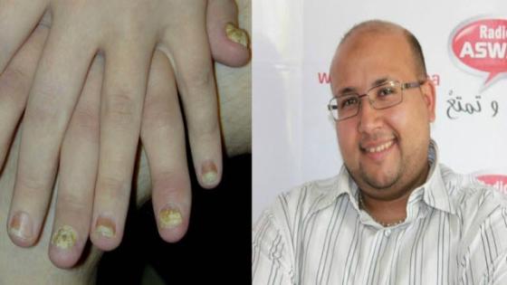 كريم الثوم والخزامى للتخلص من فطريات الاظافر و البشرة من الدكتور عماد ميزاب